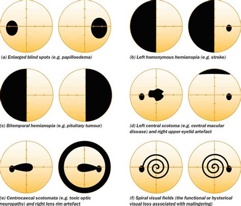 visual field testing dos and don'ts